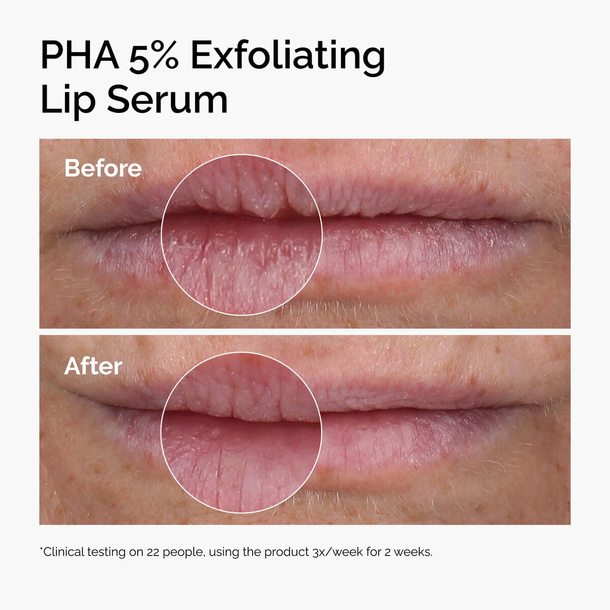 pha-5-exfoliating-lip-serum-a2 ord-pha-5pct-lip-exfoliating-serum-before-after.jpg